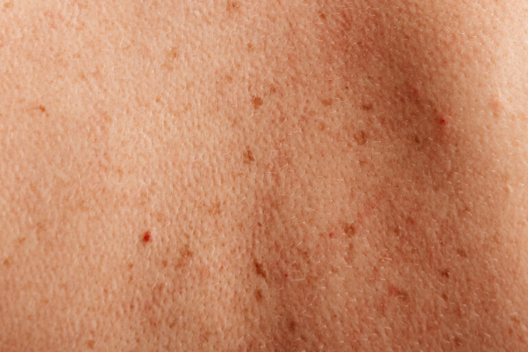 Détail de tâches de rousseur sur une peau humaine