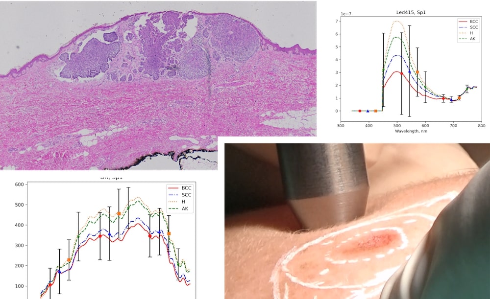 Projet SpectroLive développé au CRAN (CNRS-Université de Lorraine) en collaboration avec le CHR Metz-Thionville, avec le soutien financier du FEDER et de la Région Grand Est : photographie d'une coupe histologique d'un carcinome cutané, exemple de spectres d'autofluorescence et de réflectance diffuse et photographie de la sonde optique du dispositif de spectroscopie optique au contact de la peau d'un patient inclus dans l'étude clinique.